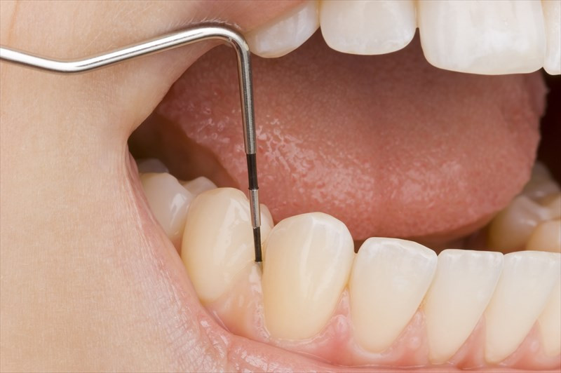 歯医者でのむし歯治療は池田で訪問診療を行う正木歯科へ